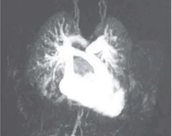 Fig. 2 - Angiorressonância nuclear magnética avaliando as artérias pulmonares e a via de saída do ventrículo direito
