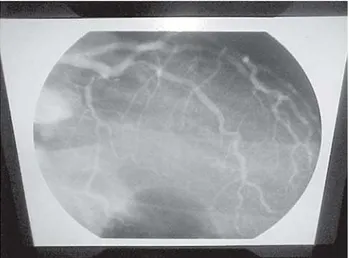 Fig. 2 - Dissecção do tronco de coronária esquerda