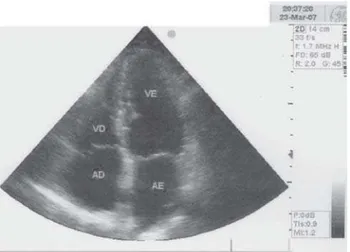 Fig. 4 - Estudo ecocardiográfico de controle, realizado 93 meses após a ressecção da tumoração
