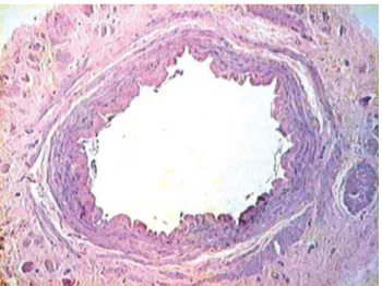 Fig. 6 - Foto de microscopia de varredura, demonstrando área desnuda de células endoteliais