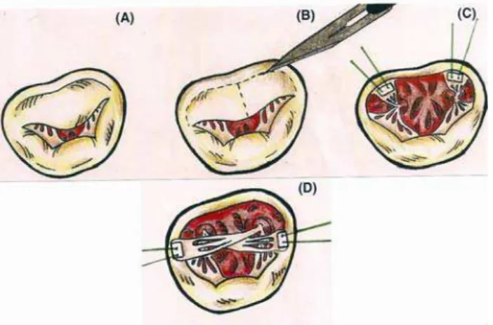 Fig. 1 - Papilopexia cruzada - A. Valva nativa. B. Desinserção da cúspide anterior. C
