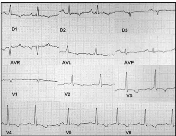 Fig. 1 - Traçado eletrocardiográfico evidenciando alterações difusas da repolarização, com inversão das ondas T