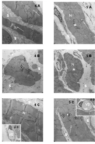 Fig. 5 - Eletromicrografias do miocárdio hipertrofiados de coelho, submetidos à parada com cardioplegia cristalóide intermitente e fria (grupo experimental II)