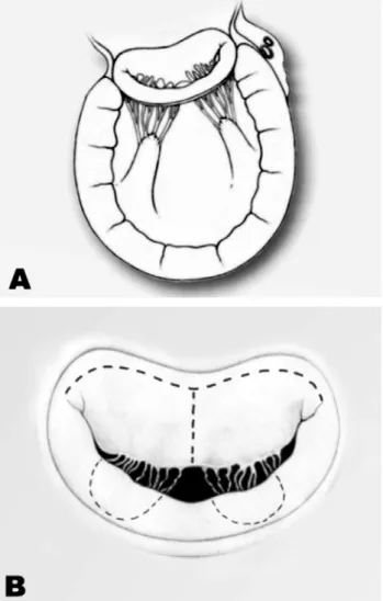 Fig. 1 - A: Anatomia do aparato subvalvar mitral. B: Anatomia da valva mitral: linhas de incisão