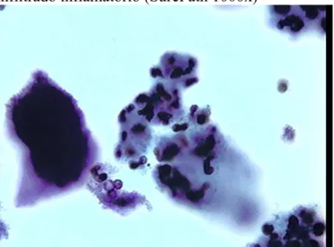 Figura - 2. Morfotipo de Actinomyces sp (seta preta) em caso de vaginose bacteriana com  infiltrado inflamatório (SurePath 1000x) 