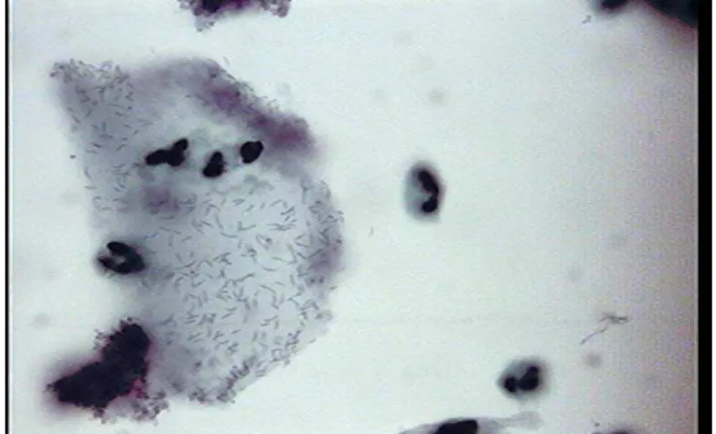 Figura 3. Morfotipo de Mobiluncus no citoplasma de célula escamosa em caso de vaginose  bacteriana com infiltrado inflamatório (SurePath 1000x) 