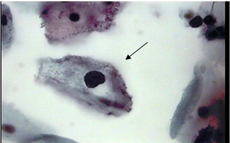 Figura - 6. Célula escamosa atípica de significado indeterminado (ASC-US) (seta) em caso de  vaginose bacteriana sem infiltrado inflamatório (SurePath 1000x) 