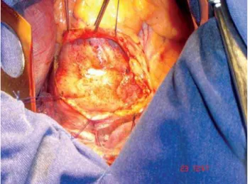 Fig. 2 - Ramo marginal da artéria circunflexa rodeado com fios de prolene 4-0