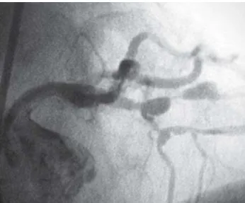 Fig. 2 - Cinecoronariografia com a imagem rotada (já corrigida) demonstrando lesões graves com aneurismas na artéria interventricular anterior