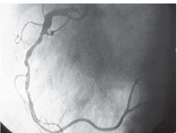 Fig. 3 - Cinecoronariografia demonstrando lesões seqüenciais em artéria coronária direita