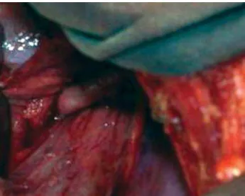 Fig. 4 - Anastomose término-lateral entre artéria carótida esquerda e artéria subclávia esquerda