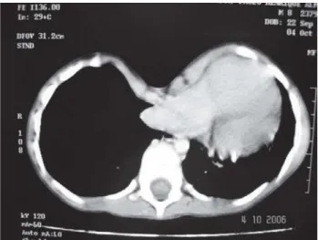 Fig. 3 - Tomografia computadorizada de tórax