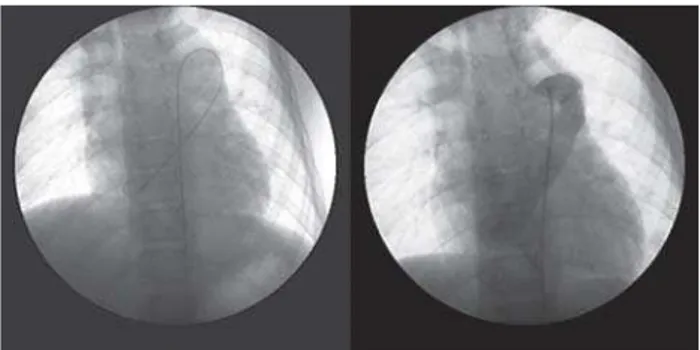 Fig. 2 - Veia ázigos (VA) e veia hemi-ázigos (VHA) dilatadas; veias supra-hepáticas (VSH) e aorta (AO); sistema ázigos dilatado (seta), posicionado à esquerda da aorta, drenando as veias renais
