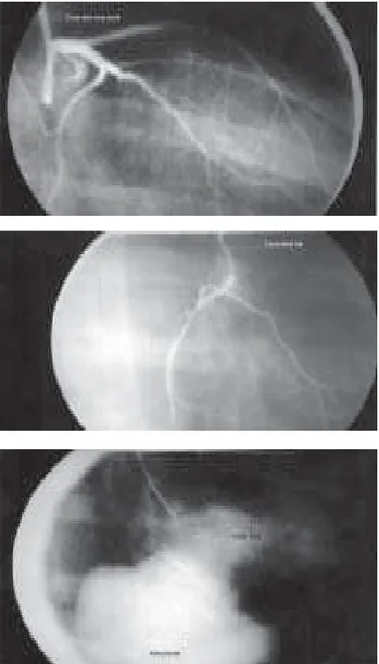 Fig. 1 - Cinecoronariografia revelando: a) Obstrução da artéria coronária direita e b) Artéria coronária esquerda normal