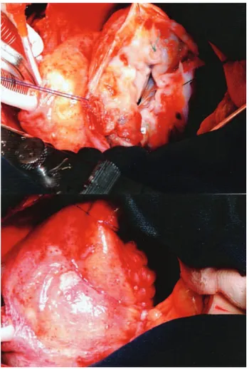 Fig. 2 - a) Aneurisma aberto; b) Reconstrução do ventrículo esquerdo por meio de sutura primária