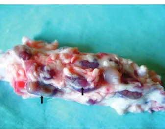 Fig. 3 - Linfoadenomegalia periaórtica limitada à região do stent.  As setas indicam os linfonodos aumentados.