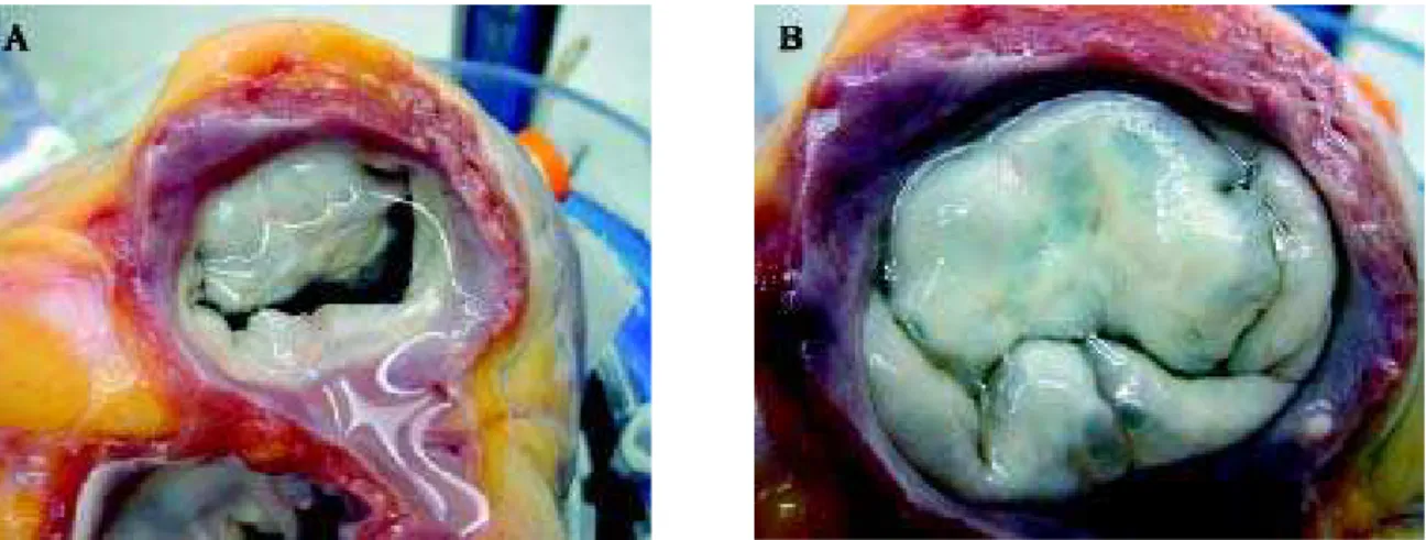 Fig. 2 - A) Início do fechamento da valva tricúspide com infusão de água no interior do ventrículo direitoD