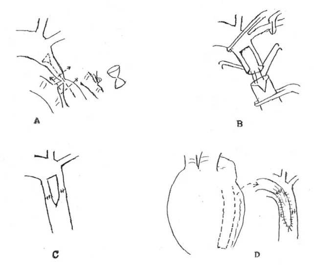 Fig. 2 – Desenho esquemático de todos os tempos cirúrgicos para execução da técnica de implante de retalho de pericárdio pediculado e vascularizado na aorta torácica