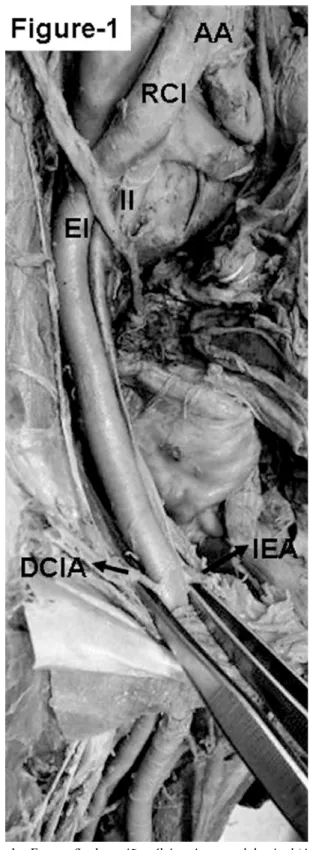 Fig. 1 – Fotografia da região pélvica. A aorta abdominal (AA) é vista dividindo no nível superior, assim como também a artéria ilíaca comum direita (ICD)