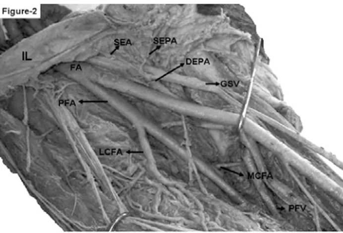 Fig. 2 – A fotografia da extremidade inferior direita. A artéria femoral (AF) dando origem a artéria femoral profunda (AFP) 1,2 cm abaixo do ligamento inguinal (LI)