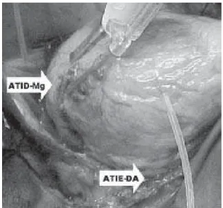 Fig. 2- Anastomose da artéria torácica interna direita (ATID) com a artéria marginal (Mg)