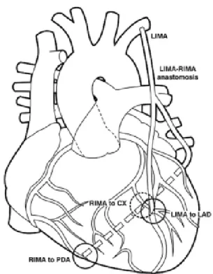 Fig. 1 - Técnica de revascularização arterial exclusiva mais freqüentemente utilizada