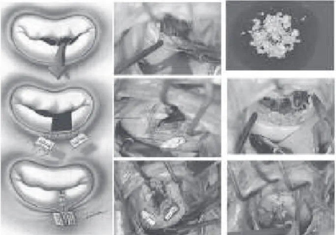 Fig. 3 - Sobrevida livre de reoperação