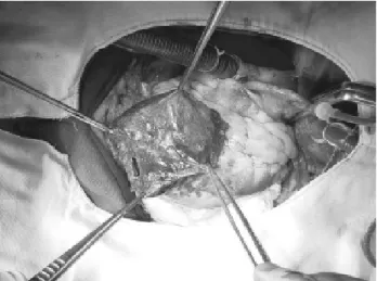Fig. 1 - Aneurisma em parede anterior de ventrículo esquerdo roto
