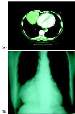Fig. 2 - (A)Tomografia computadorizada e (B)radiografia de tórax pré-operatórias