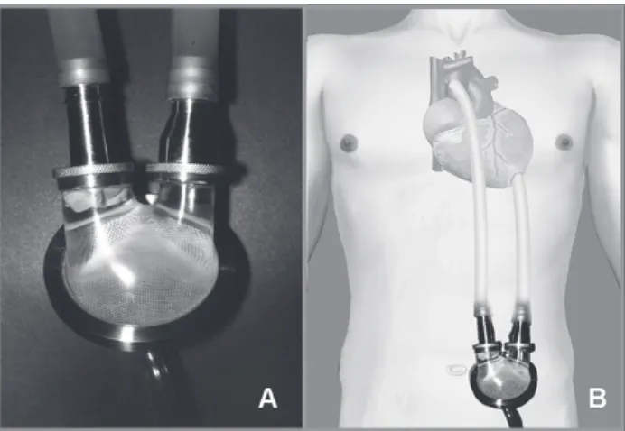 Fig. 1 - Fotografia (A) e representação esquemática (B) do dispositivo paracorpóreo de assistência ventricular InCor, implantado como suporte circulatório em paralelo aos ventrículos direito e esquerdo