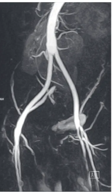 Fig. 2 - Ressonância magnética de angiografia identificando anastomose proximal término-lateral acima do nível das  artérias renais acessórias