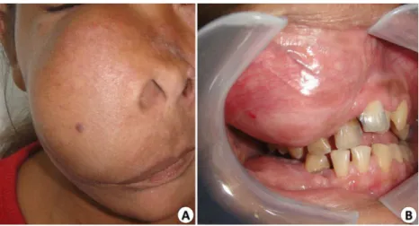 Fig. 2 Radiopaque image with imprecise limits in the anterior maxilla involving the maxillary sinus