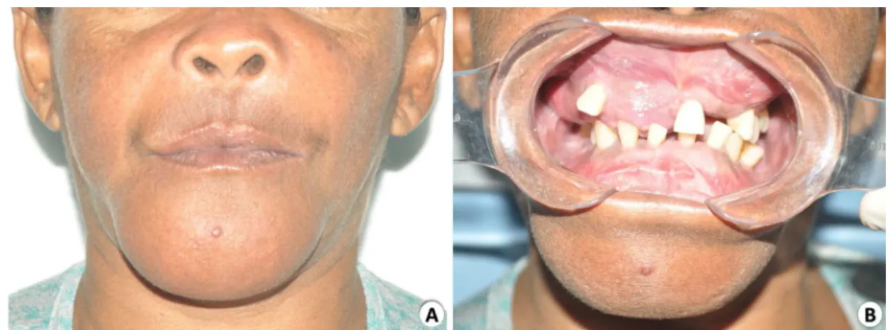 Fig. 6 Panoramic radiography (patient 2) displaying marked expansion of bone structures with ground-glass appearance and several teeth with hypercementosis