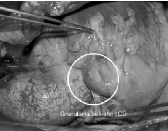 Fig. 4 - Corte histológico transversal da artéria coronária com a presença de trombo na luz vascular substituído por proliferação fibroblástica com recanalização