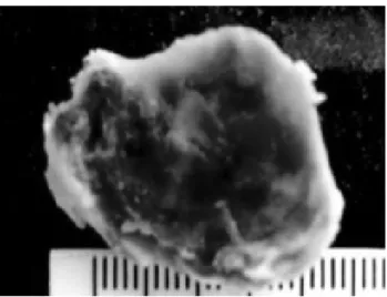 Fig. 1 – Estudo hemodinâmico evidenciando o Hemangioma Fig. 2a - Hemangioma - Aspecto macroscópico