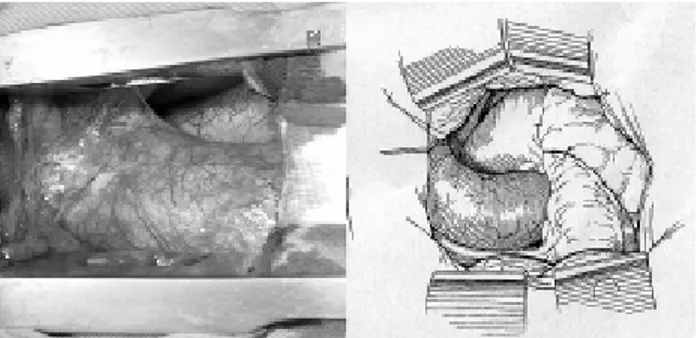 Fig. 3 - Foto e desenho demonstrando a exposição da aorta ascendente na perspectiva do cirurgião
