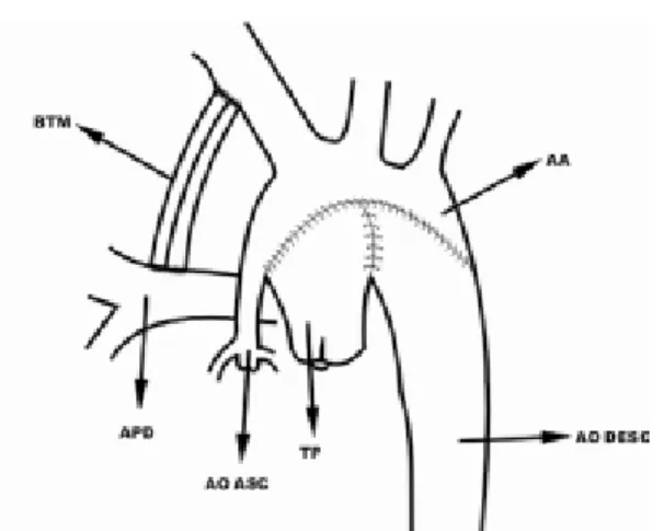 Fig. 1 - Desenho esquemático da técnica cirúrgica empregada.