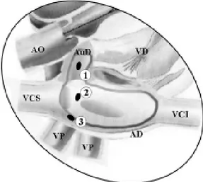 Fig. 1 - Esquema dos focos de taquicardia atrial ectópica na parede posterior da aurícula direita (1), na porção septal superior (2) e na parede livre do átrio direito(3)[19-21]