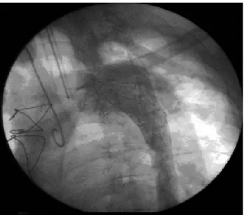 Fig. 2 – Aortografia realizada após correção cirúrgica da dissecção mostra troca valvar aórtica com colocação de prótese biológica de pericárdio bovino, prótese tubular em aorta ascendente normal e implante de sistema endovascular auto-expansível via femor