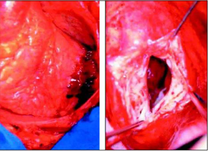 Fig. 2 – Rotura cardíaca sub-aguda.