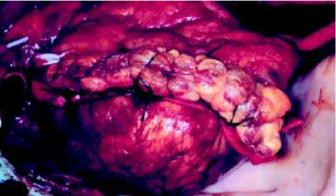 Fig. 4 – Rotura cardíaca subaguda. “Pseudo-aneurisma ventricular” tratamento cirúrgico.