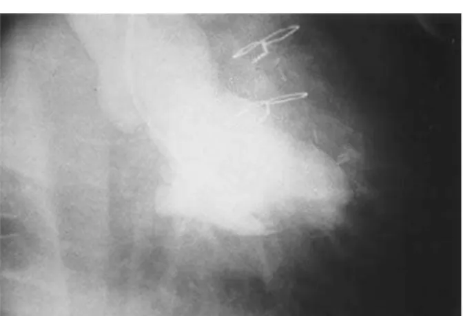 Fig. 2 – Foto de ventriculografia em sístole em após correção cirúrgica.