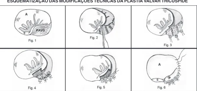 TABELA 2. ACHADOS INTRAOPERATÓRIOS EM 6 PACIENTES PORTADORES DE ANOMALIA DE EBSTEIN SUBMETIDOS A PLASTIA DA VALVA TRICÚSPIDE