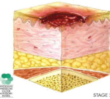 Figura 3 - Úlceras por Pressão em Estágio II  