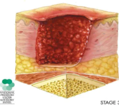 Figura 4 - Úlceras por Pressão em Estágio III  
