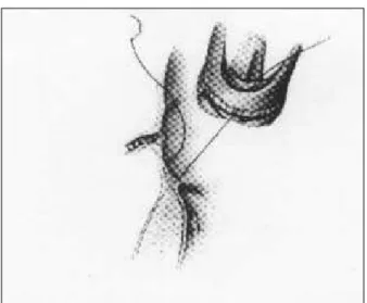 Fig. 4 - Linha de sutura única exteriorizada e amarrada no topo dos postes comissurais (reproduzida com permissão do Dr