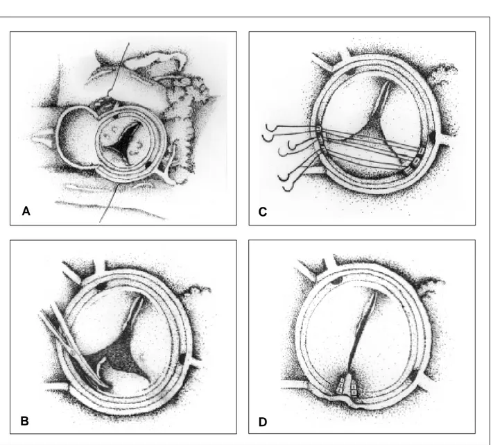 Fig. 1 –  A.  Desenho que representa a valva aórtica competente; B. Ressecção da válvula aórtica não coronariana; C
