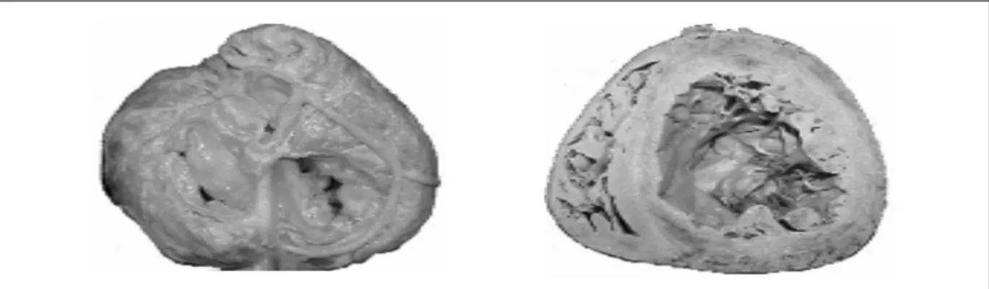 Fig. 1 – Coração com CMD após rebatidas as cavidades atriais expondo as valvas atrioventriculares esquerda e direita (esquerda)