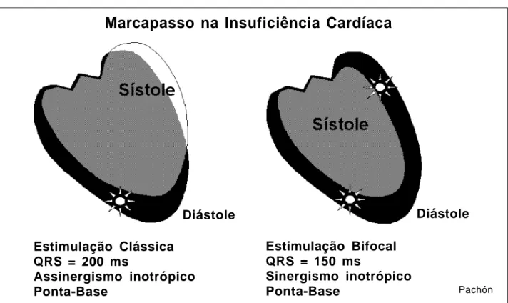 Fig.  3  - Esquema representativo do prejuízo contrátil ocasionado pela falta de sincronismo inotrópico em decorrência da condução miocárdica lenta.