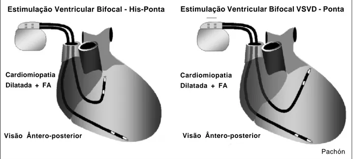 Fig. 4 - Esquema representativo das posições dos eletrodos. Estimulação na região do feixe de His ou na via de saída do ventrículo direito (septal) e a ponta do ventrículo direito (convencional).